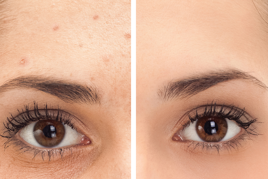 tratamiento para reducir el acné blanquemiento facial y mejorar la textura de la piel