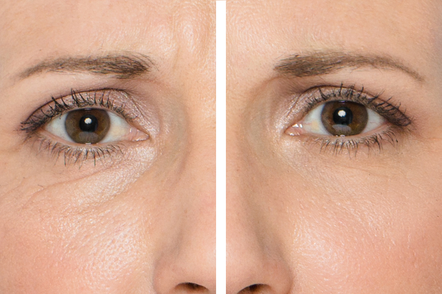 tratamiento para refinar el contorno de ojos
